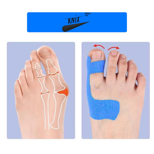 KniX™ | Ballenzeh (Hallux valgus)